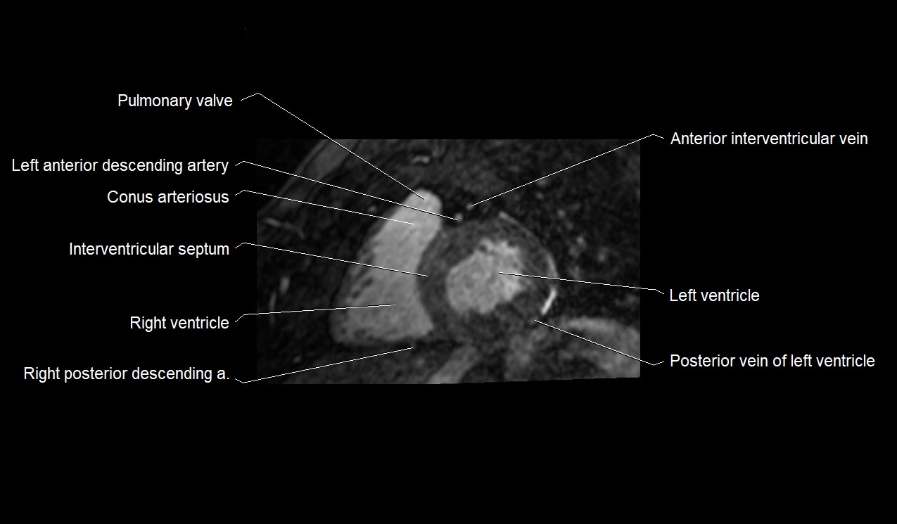 MRI heart and coronary arteries short axis anatomy image 23.webp